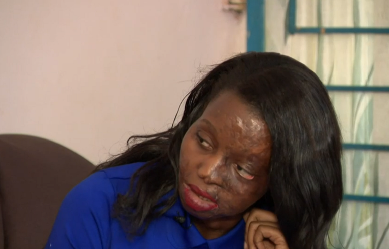 Preživjela je napad kiselinom: "Užasno je,  kao da ti netko kopa ispod kože"